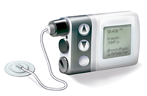 Insulin pump.