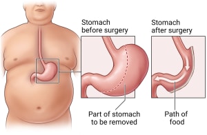 Front view of a person's body showing their stomach in their abdomen. Two insets show the stomach before and after surgery to remove part of the stomach.