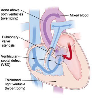 Four-chamber view of heart showing Tetralogy of Fallot, which is aorta above both ventricles, pulmonary stenosis, ventricular septal defect, and thickened right ventricle. Arrows indicate blood flow from left ventricle to right ventricle and into aorta. Some blood flows from right side of heart to pulmonary artery.