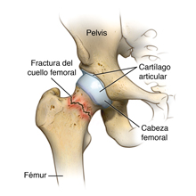 Fractura del cuello femoral